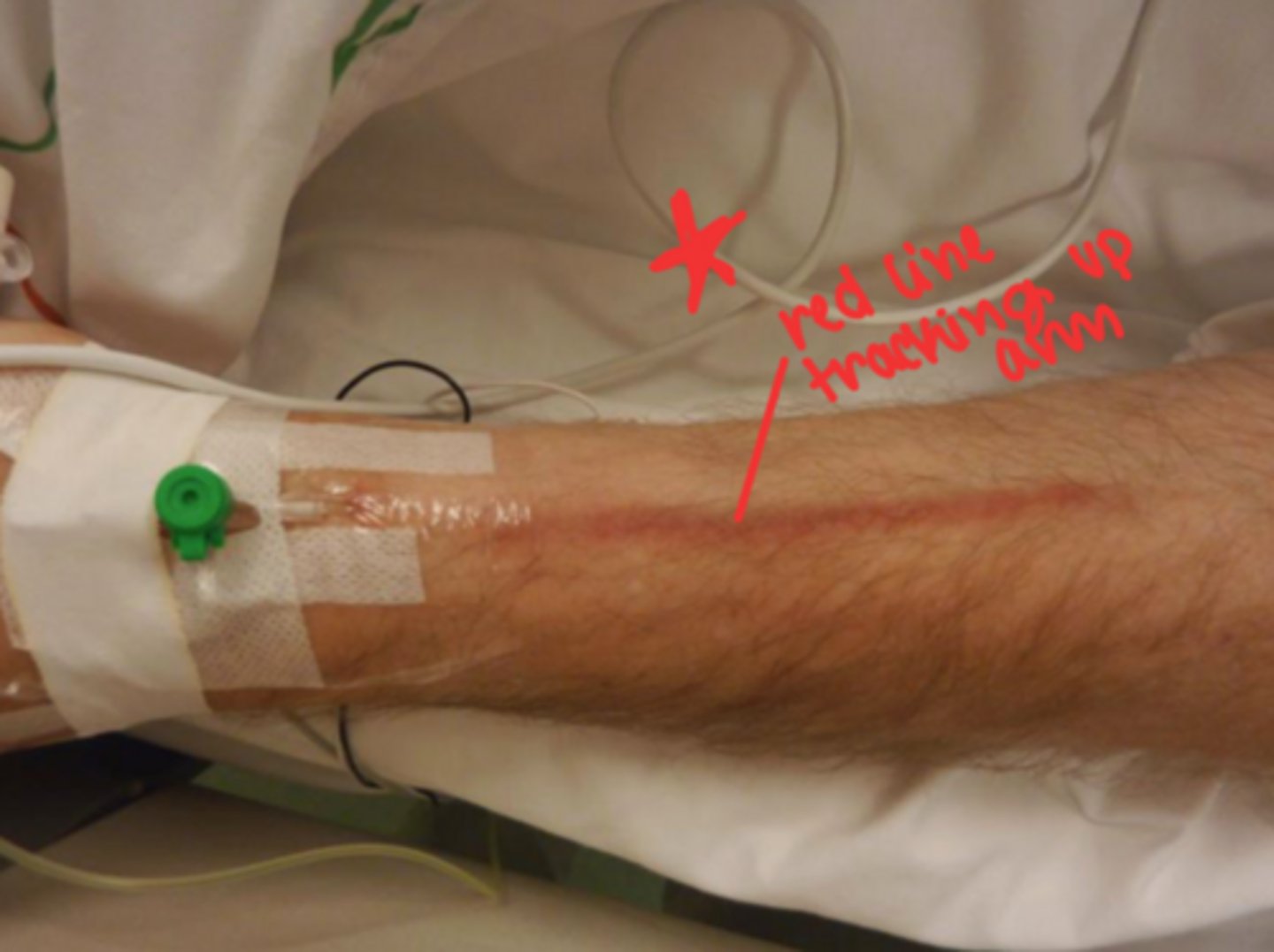 <p>inflammation of a vein</p>