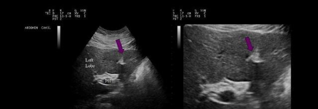 <p>The purple arrows point to which of the following liver structures?</p>