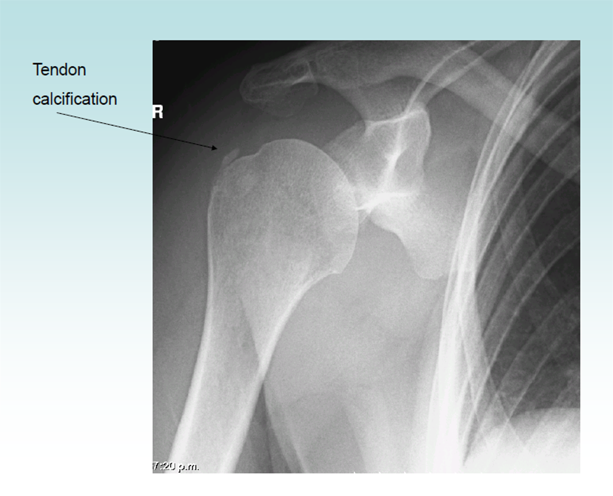 <p>calcium deposits in the rotator cuff</p>