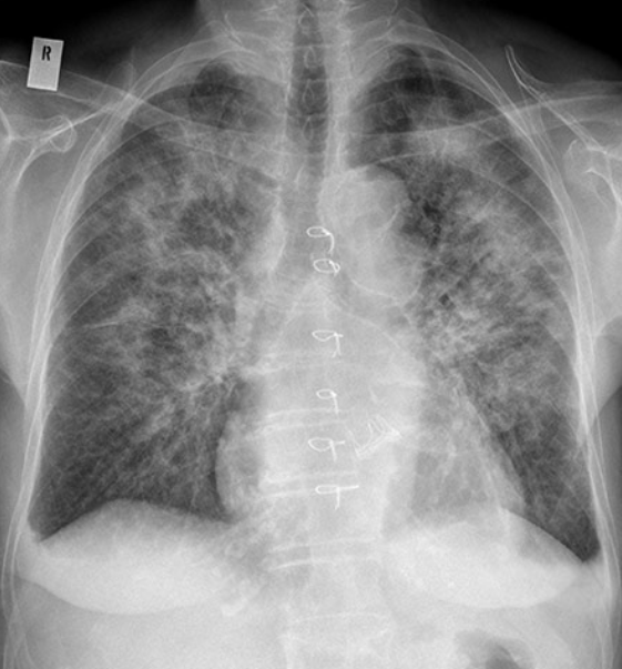 <p>What’s wrong with this CXR?</p>