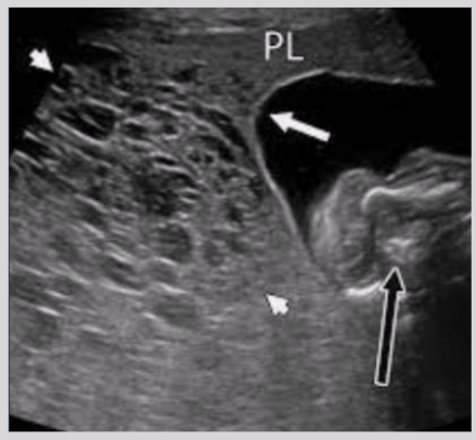 <ul><li><p><span style="background-color: transparent;">Molar placenta - grossly enlarged placenta + cystic areas</span></p></li><li><p><span style="background-color: transparent;">focal/diffuse areas of increased echogenicity in or around placenta&nbsp;</span></p></li><li><p><span style="background-color: transparent;">Presence of fetal tissue</span></p></li></ul><p></p>