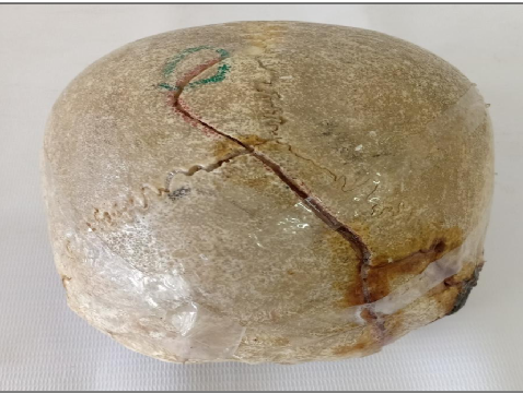 <p>Questions</p><ol><li><p>What is the specimen being examined?</p></li><li><p>What are the type and descriptive features of the fracture?</p></li><li><p>What type of causative instrument and force mechanics produce this injury?</p></li><li><p>How is the time of death estimated?</p></li><li><p>What are the possible causes of death?</p></li><li><p>What is the final diagnosis for this specimen?</p></li></ol><div data-type="horizontalRule"><hr></div><p></p>