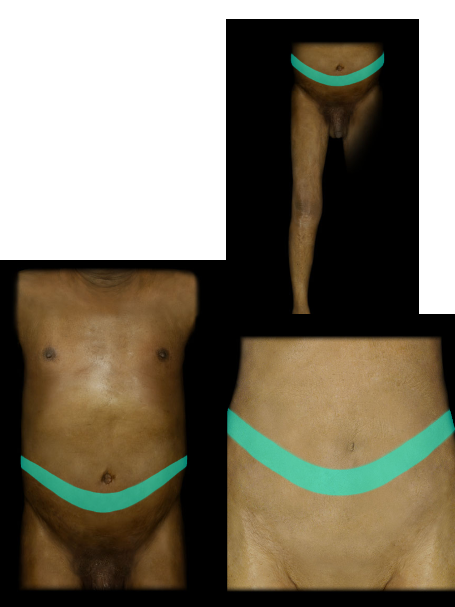 <p>T11 Dermatome</p>
