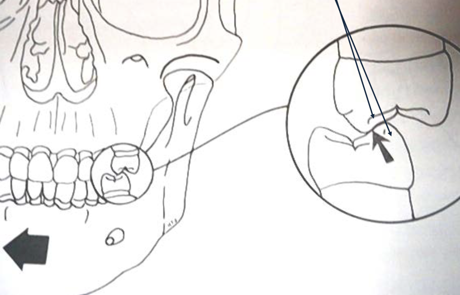 <ul><li><p>two inner inclines</p></li><li><p>two supporting cusps</p></li></ul><p></p>