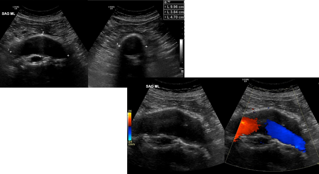 <p>abdominal aortic aneurysm (AAA)</p>