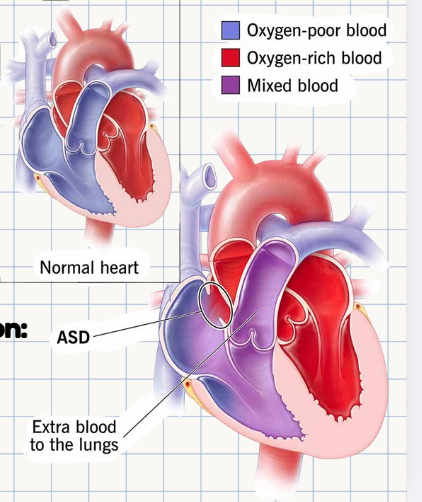 <p>Atrial Septal Defect (ASD)</p><p>What is the <strong>most common</strong> anatomical location and specific classification type for an ASD?</p>