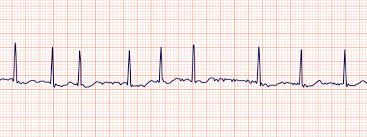 <p>ECG Patterns: Afib/Aflutter</p>