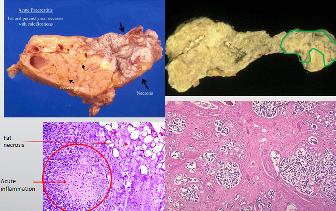 <p>what’s the difference between acute and chronic pancreatitis? </p>