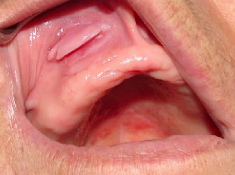 <p>benign growth in the gum tissue, often caused by irritation or trauma.</p>
