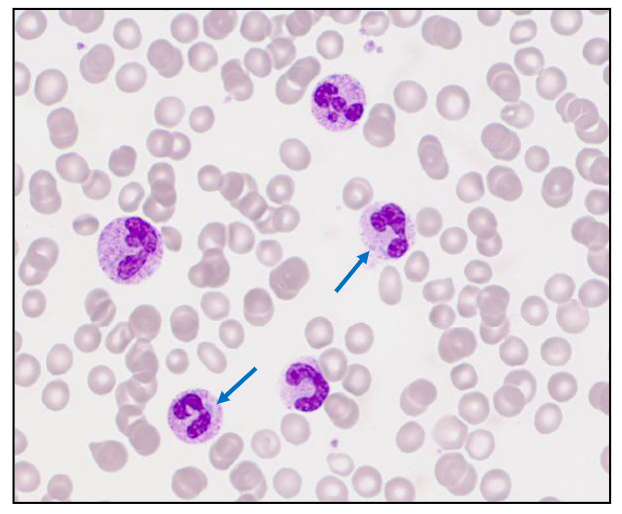 <p>- Basophillic neutrophil cytoplasmic inclusions</p><p>- Evidence of long-standing severe bacterial sepsis</p>