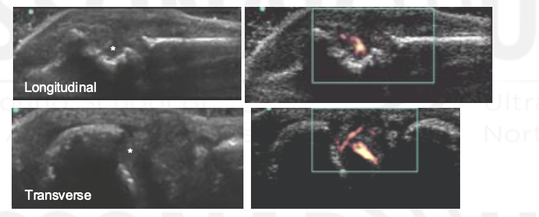 <p>True or false: </p><p>Synovial thickness scores + Doppler pixel scores from the MCPs correlate with progression of the modified Sharp score at 1 year.</p>