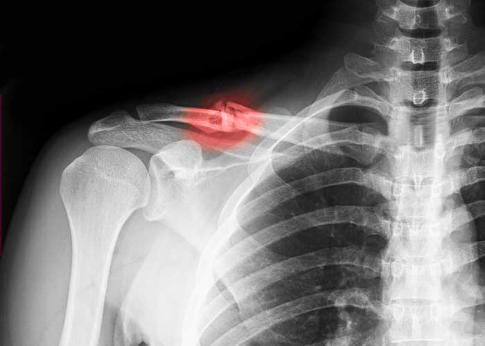 <p>What bandaging technique should be used for this injury?</p>