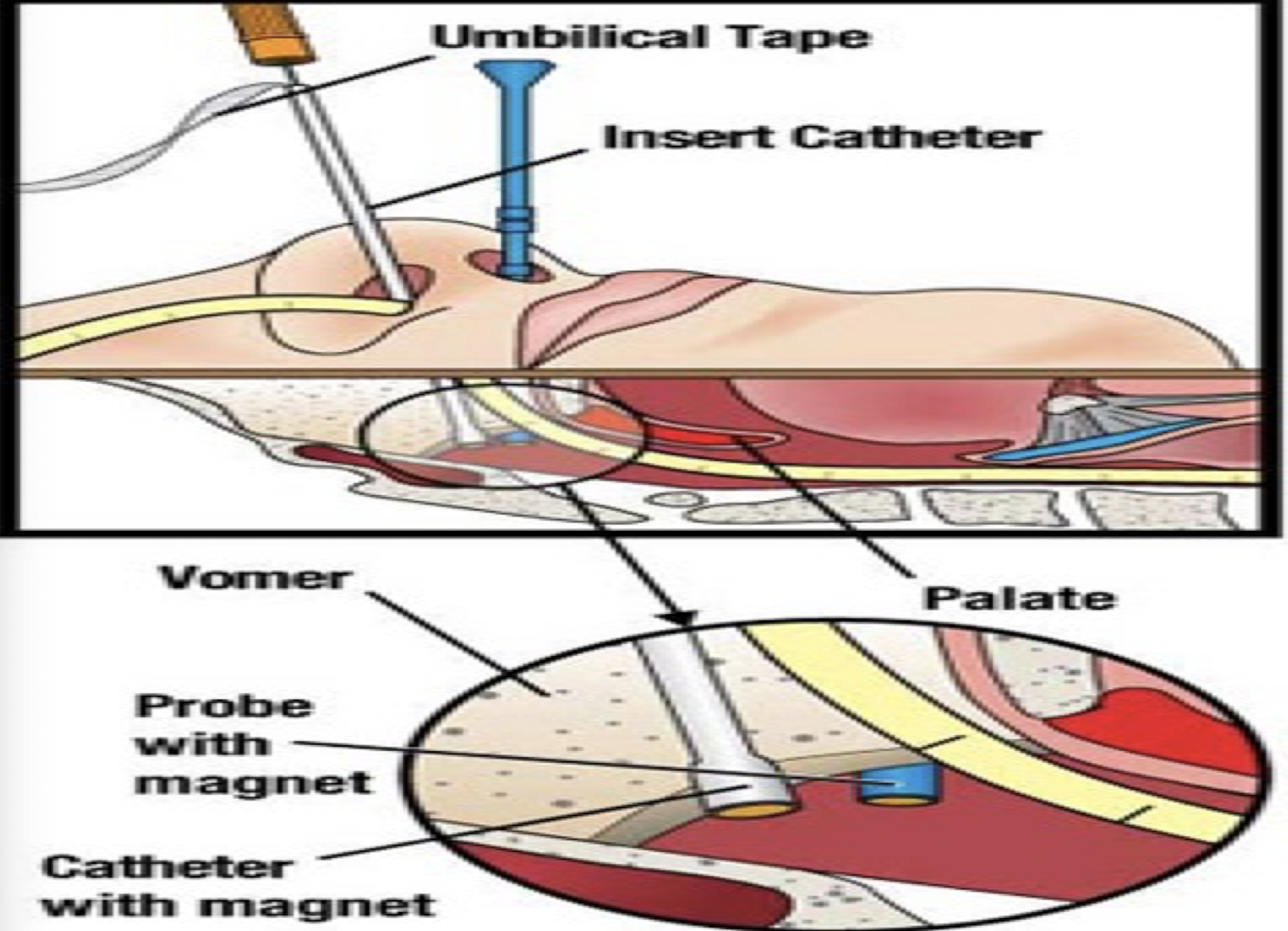 <p>-Prevents dislodgment</p><p>-Patient supine, tube inserted into nare</p><p>-Probe inserted into other nostril (cloth tape attached)</p><p>-In nostril with tube, bridle catheter inserted→ the catheter and probe each have a magnet, will hear them click together</p><p>-Withdraw probes- just cloth left→ clip two pieces of cloth together on tube and cut off extra</p>