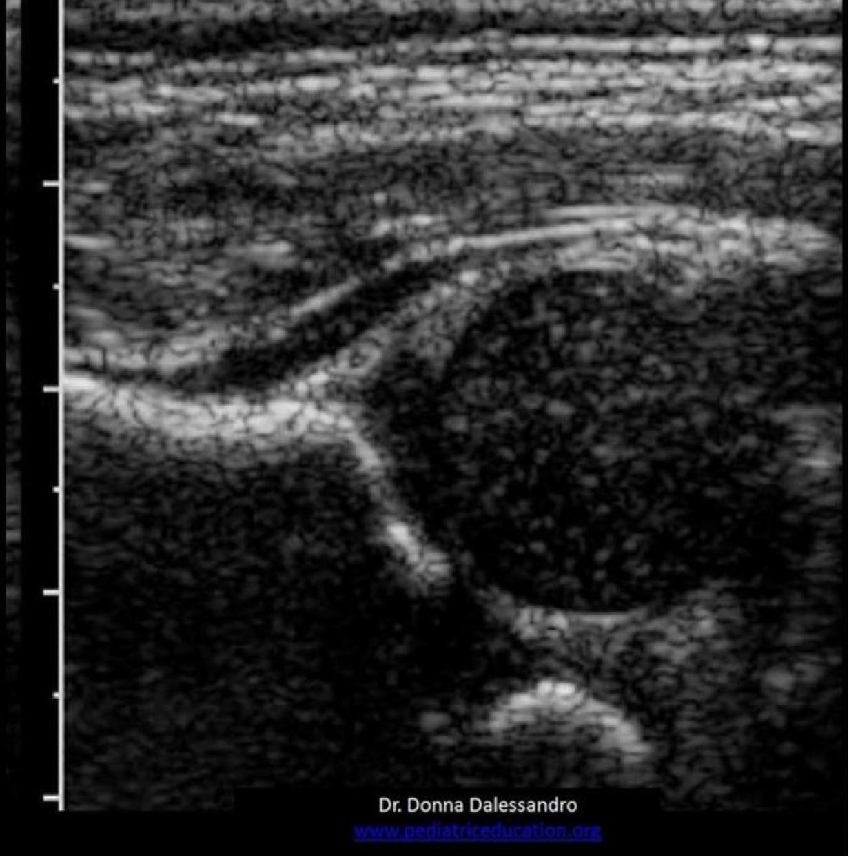 <p>Locate the ilium</p>