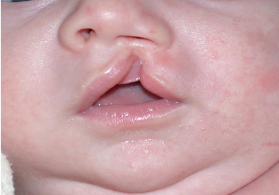 <ul><li><p>a thin, soft tissue bridge that connects the borders of a cleft lip, typically found at the base of the nostril or along the alveolar ridge.</p></li></ul><p></p>