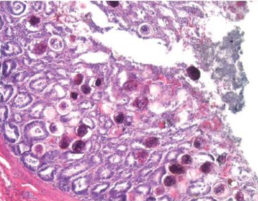 <p>Schistosomiasis: Disease</p>