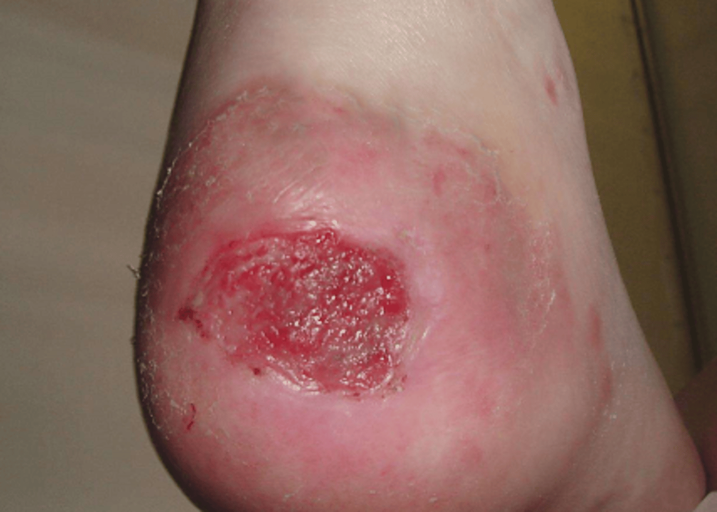 <p>full thickness</p><p>skin loss fo dermis and/or epidermis</p><p>adipose visible</p><p>slough/ eschar may be present</p><p>no tendon, muscle, or bone</p>