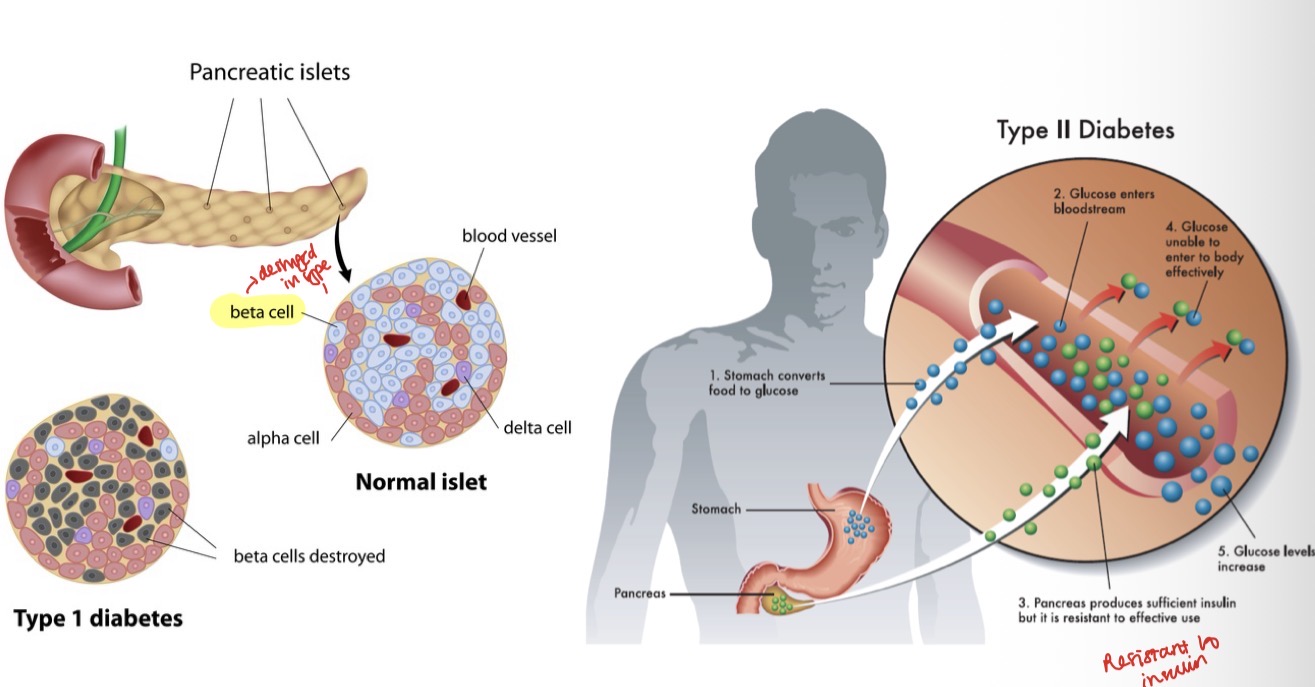 <p>Stop smoking, control diabetes- increases prevalence, progression and severity of periodontitis</p><p>Type 1- lack of insulin due to autoimmune reaction in pancreas</p><p>2- insulin resistance associated with chronically high blood sugar</p>