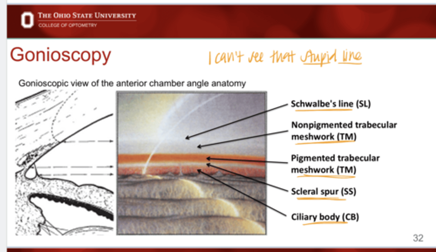 <p>Gonioscopic view of the Anterior Chamber Anatomy</p>