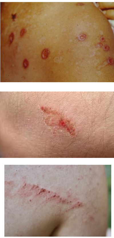 <p>What kind of lesion is this?</p>
