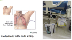 <p>To remove air, fluid, or blood from the pleural cavity</p>