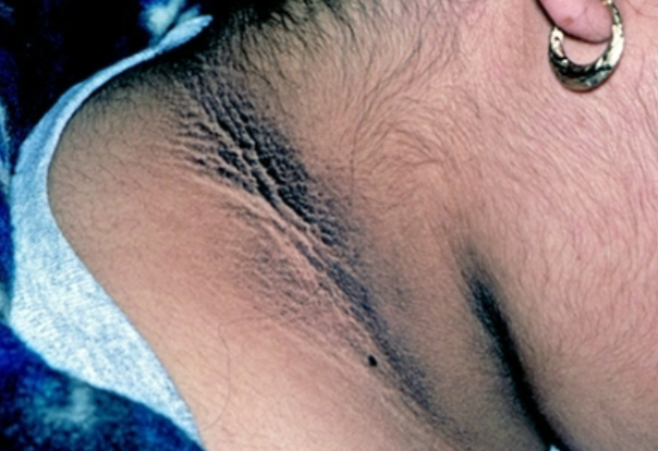 <p>Acanthosis nigricans*</p>