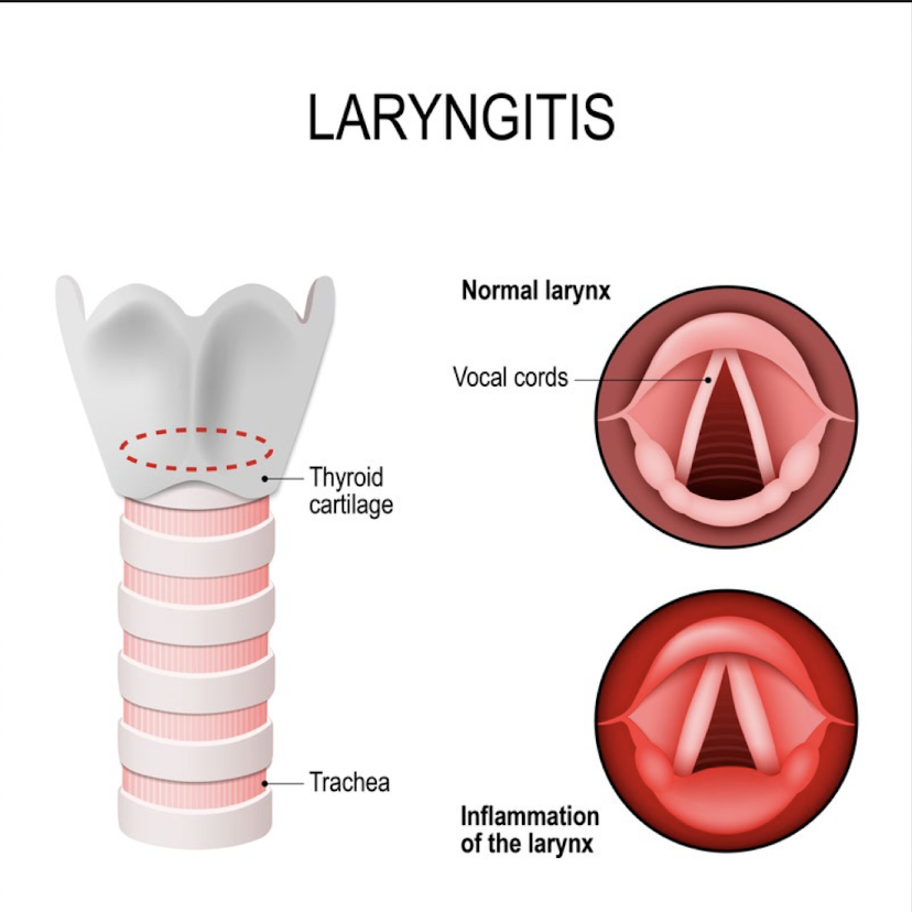 <p>Laryngitis definition</p>