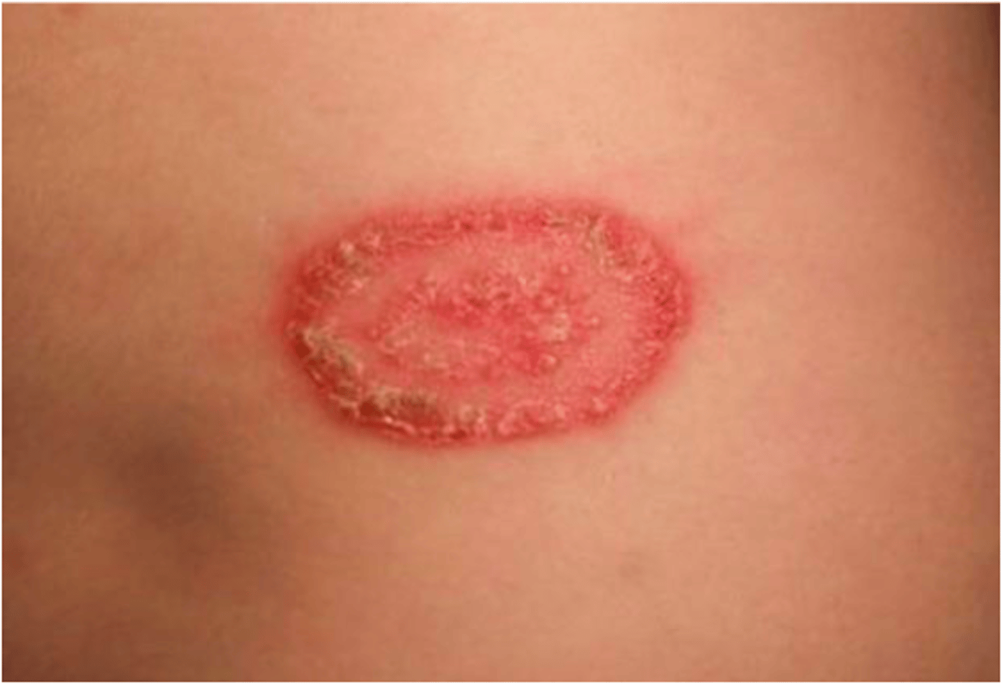 <p>fungal infection of the skin and appendages</p>