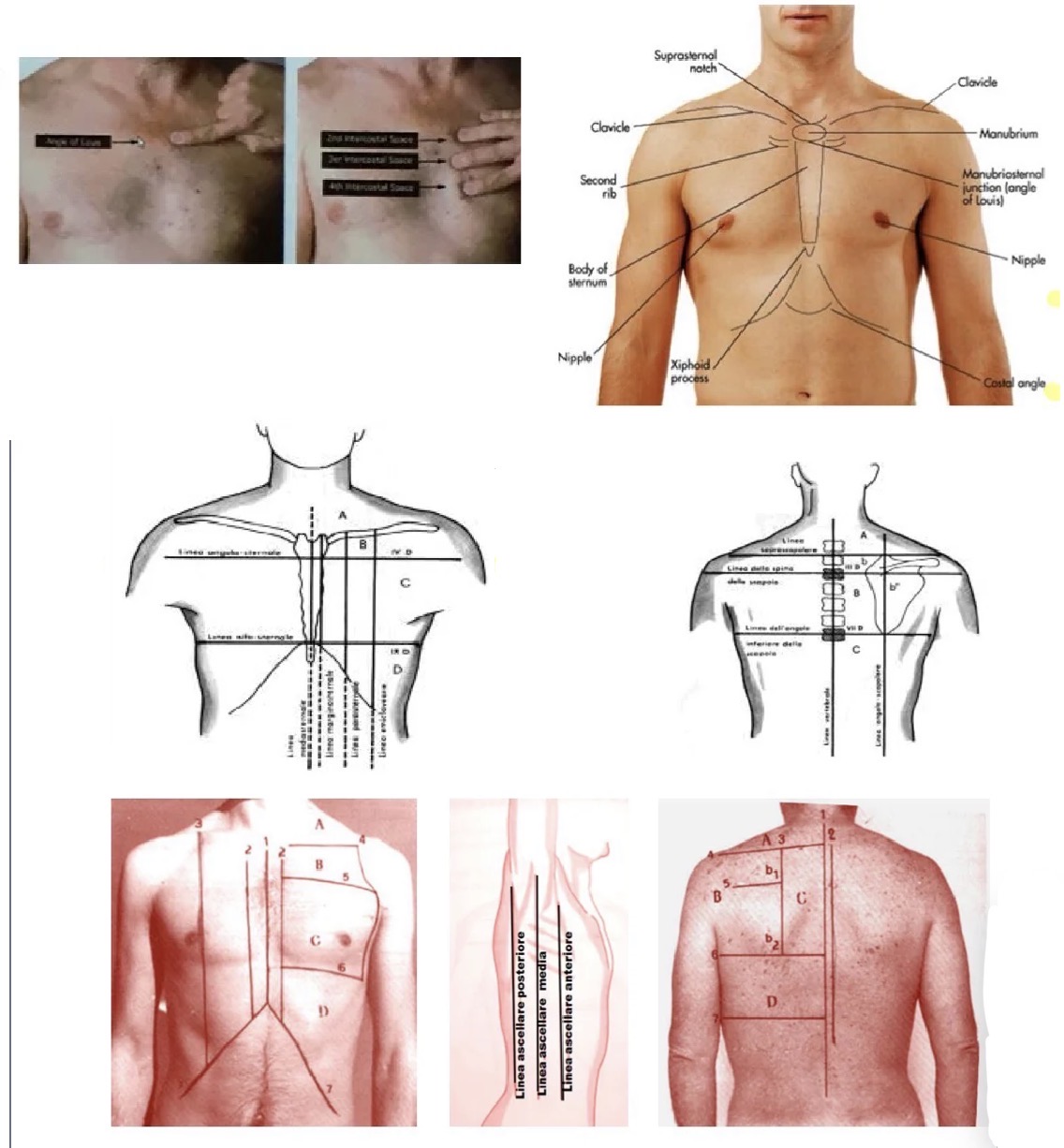 <p><span>• </span><strong><span>Posizione del paziente:</span></strong><span> Esaminato prima posteriormente (per torace post. e polmoni), poi anteriormente in posizione seduta.</span></p><p><span>• </span><strong><span>Punti di repere anteriori:</span></strong></p><p><span>• Angolo di Louis (sternale): Articolazione manubrio-corpo sternale; si trova 5 cm sotto l'insicura del giugulo. Lateralmente si localizza la 2ª costa; sotto vi è il 2° spazio intercostale (sede per elettrodi ECG e auscultazione cardiaca).</span></p><p><span>• Manovra conta coste: Partendo dall'Angolo di Louis, porre 2 dita (indice e medio) nel 2° spazio intercostale e scendere obliquamente un dito alla volta.</span></p><p><span>• Punto emiclaveare: Centro della clavicola.</span></p><p><span>• Processo xifoideo: Corrisponde alla 6ª costa o 6° spazio intercostale.</span></p><p><span>• </span><strong><span>Punti di repere posteriori:</span></strong></p><p><span>• Angolo inferiore scapola: Livello 7ª costa o 7° spazio intercostale.</span></p><p><span>• Processo spinoso 7ª vertebra cervicale (C7): Punto di partenza per contare i processi spinosi toracici.</span></p><p><span>• 11ª e 12ª costa: Palpabili posteriormente; usate per contare le coste dal basso.</span></p><p><span>• </span><strong><span>Regioni anatomiche:</span></strong></p><p><span>• Anteriori: Sopraclavicolare/collo; sottoclavicolare (tra clavicola e linea orizzontale passante per Angolo di Louis); mammaria (fino al processo xifoideo); ipocondrio (sotto l'arcata costale).</span></p><p><span>• </span><strong><span>Linee immaginarie:</span></strong></p><p><span>• Anteriori: Mediosternale, marginosternale, emiclaveare, parasternale.</span></p><p><span>• Laterali: Ascellare anteriore, ascellare posteriore, ascellare media.</span></p><p><span>• Posteriori: Soprascapolare, linea della spina della scapola (corpo 3ª vertebra dorsale), linea dell’angolo inferiore scapola, mediovertebrale, angolo-scapolare.</span></p><p><span>• Regioni posteriori identificate: Sottoscapolare/dorsale, scapolare, interscapolovertebrale, soprascapolare. Limitato inferiormente dalla 12ª costa.</span></p>