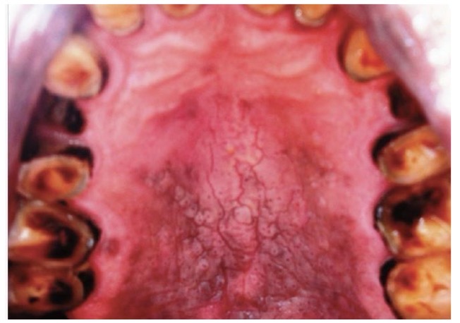 <p>BN NAM, HÚT THUỐC LÂU NĂM</p><p>NỔI CÁC NỐT ĐỎ Ở VÒM MIỆNG </p><p>CHẨN ĐOÁN ?</p>