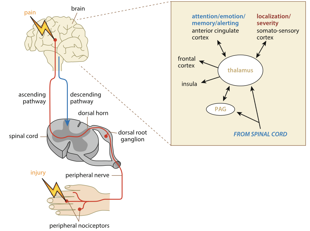 <p><strong><em><mark data-color="purple" style="background-color: purple; color: inherit;">PAG (Periaqueductal gray matter)</mark>:</em></strong> Found in the <mark data-color="yellow" style="background-color: yellow; color: inherit;">brain stem</mark>, origin of descending inhibitory pathway from the brain. Descending neural pathway from brain to spinal cord.</p><ul><li><p>When pain signals reach the brain, neurons in the PAG are activated</p></li><li><p>PAG neurons send inhibitory signals <strong><mark data-color="yellow" style="background-color: yellow; color: inherit;">down the spinal cord</mark></strong></p></li><li><p>Prevents further pain signals from reaching the brain</p></li><li><p>Acts on the <strong><em><u><mark data-color="purple" style="background-color: purple; color: inherit;">second-order neuron</mark></u></em></strong> in the <strong><mark data-color="purple" style="background-color: purple; color: inherit;">spinothalamic tract</mark></strong></p></li></ul><p></p>