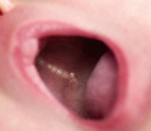<p>due to arises from the <span style="color: red;">mucosa gland elements</span></p><p>an example of nodules that is seen <span style="color: red;">on palates</span> of new born infants. (palatine cyst)</p>