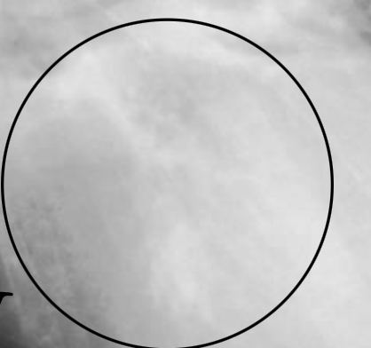 <p>What valve is shown here in this endocarditis radiograph?</p>