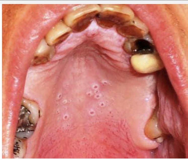 <p>BN NAM </p><p>HÚT THUỐC LÁ LÂU NĂM </p><p>CHẨN ĐOÁN?</p>