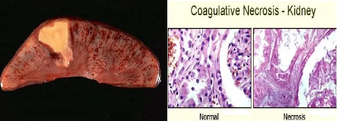 <p>What type of necrosis is this?</p>