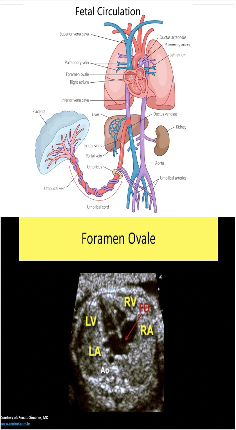 <p>B. foramen ovale</p><p>The foramen ovale normally closes very soon after birth. The ductus arteriosus describes the connecting vessel from the main pulmonary trunk to the descending aorta in fetal circulation. It functions as a shunt to bypass the fetal lungs. The ductus venosus describes the vessel that shunts blood flow around the fetal liver in fetal circulation. Both ductus connections also close shortly after birth.</p>
