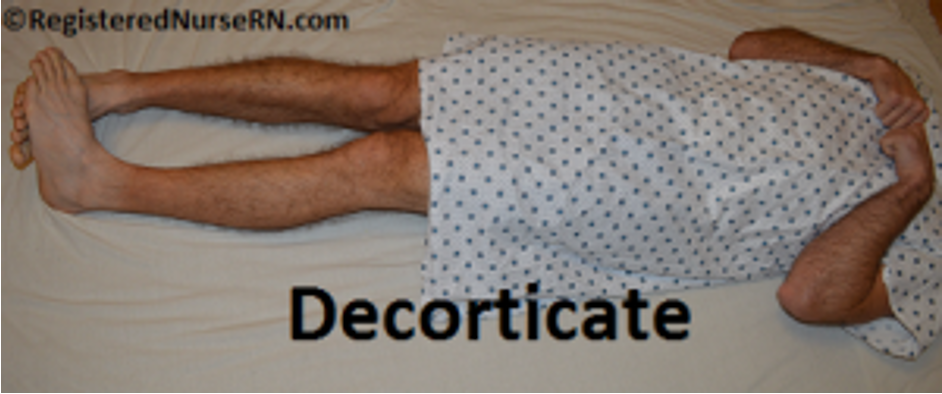 <p><span>Decorticate Posturing</span></p>