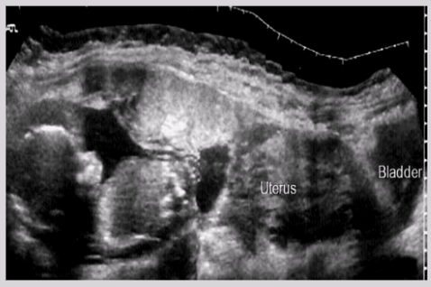 <ul><li><p>Gestational sac implants into abdominal cavity</p></li><li><p><span style="background-color: transparent;">Symptoms: general malaise, nausea, vomiting, vaginal bleeding</span></p></li><li><p><span style="background-color: transparent;">Risk factors: PID, endometriosis, tubal damage</span></p></li><li><p><span style="background-color: transparent;">Possible sites: spleen, UT surface, liver, diaphragm, bowel, etc.</span></p></li></ul><p></p>
