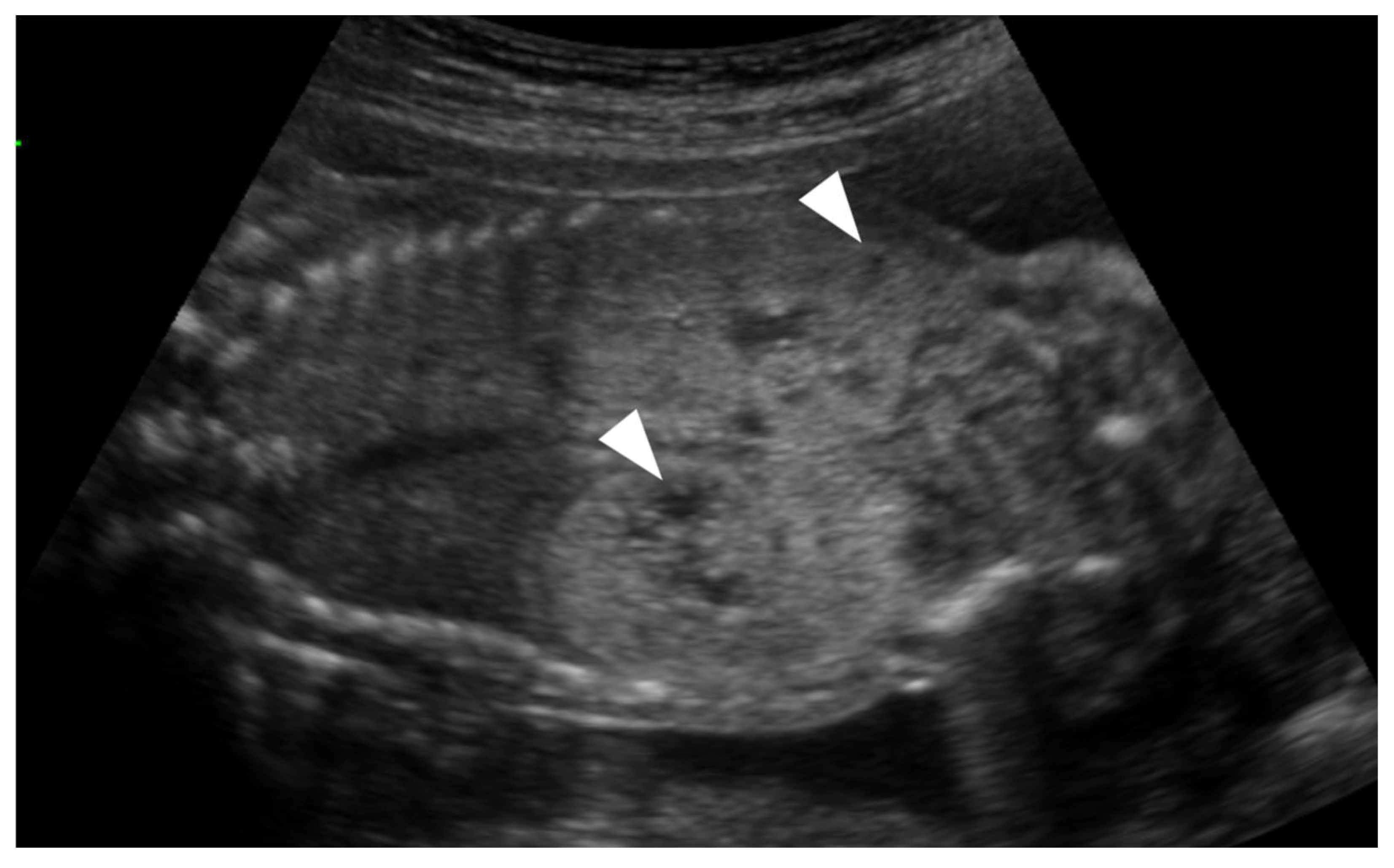 <p>Normal-appearing or bilateral, enlarged echogenic kidneys</p><p>Visible urinary bladder</p><p>Normal amniotic fluid volume</p><p>Cysts often do not manifest until approximately the fifth decade of life</p>