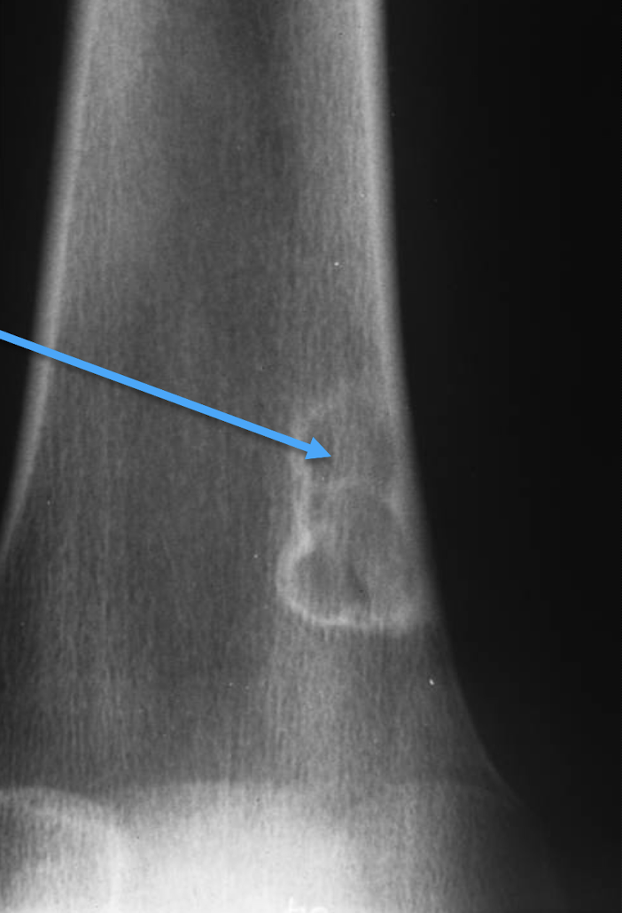 <p>What bone tumour is this, what bone is it in and what can be seen?</p>
