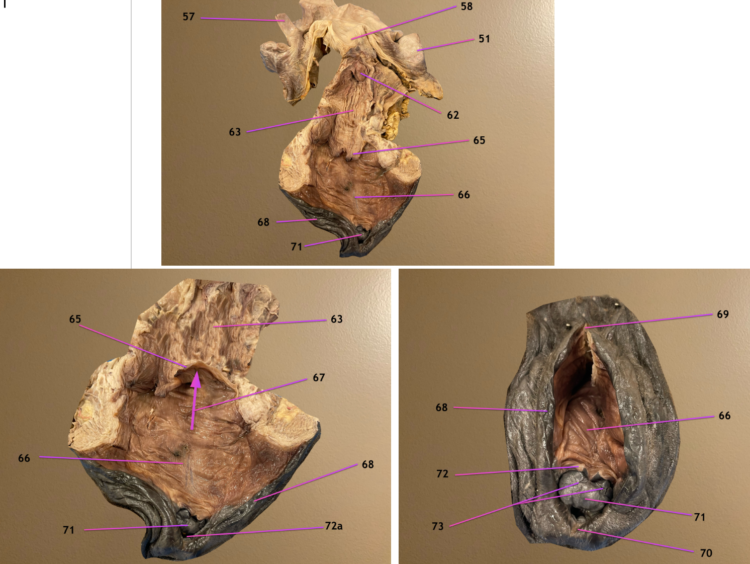 <p>pic 1: dorsal view of female repro tract</p><p>pic 2: same but zoomed in</p><p>pic 3: cd to cran view of repro tract</p><p>.</p><p>label 67-70</p>