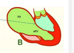 <ul><li><p>Moderate apical displacement</p></li><li><p>Moderately enlarged atrialized RV with reduced function</p></li><li><p>Reduced functional RV volume but adequate function</p></li></ul><p></p>