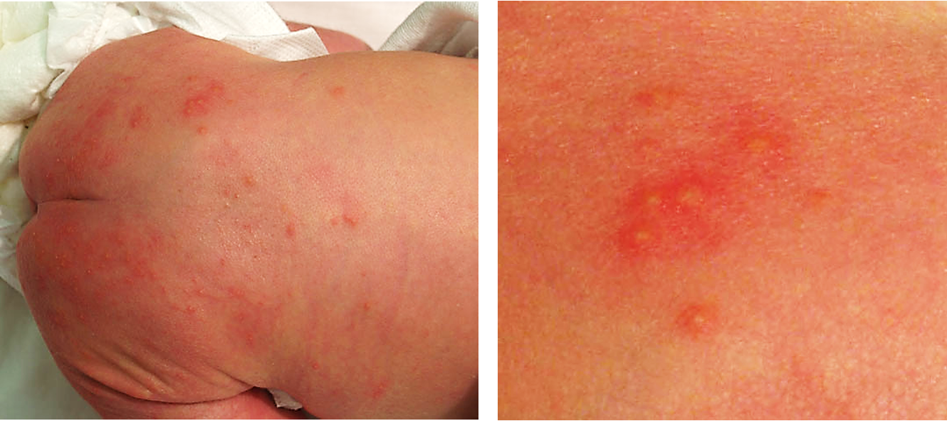 <p>24-48 hrs after birth, resolves around 1 week </p>