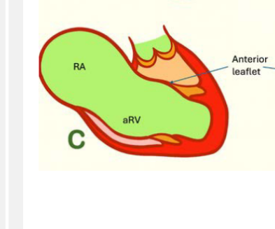 <ul><li><p>Severe apical displacement</p></li><li><p>Abnormal attachments that restrict anterior leaflet mobility, potentially RVOT obstruction</p></li></ul><p>• large "atrialized" ventricle with reduced function</p><p>• small functional right ventricle</p><p></p>