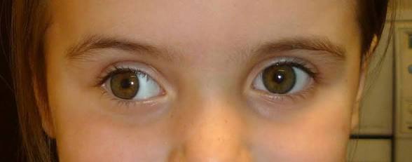 <p>Desalineación de los ojos. </p>