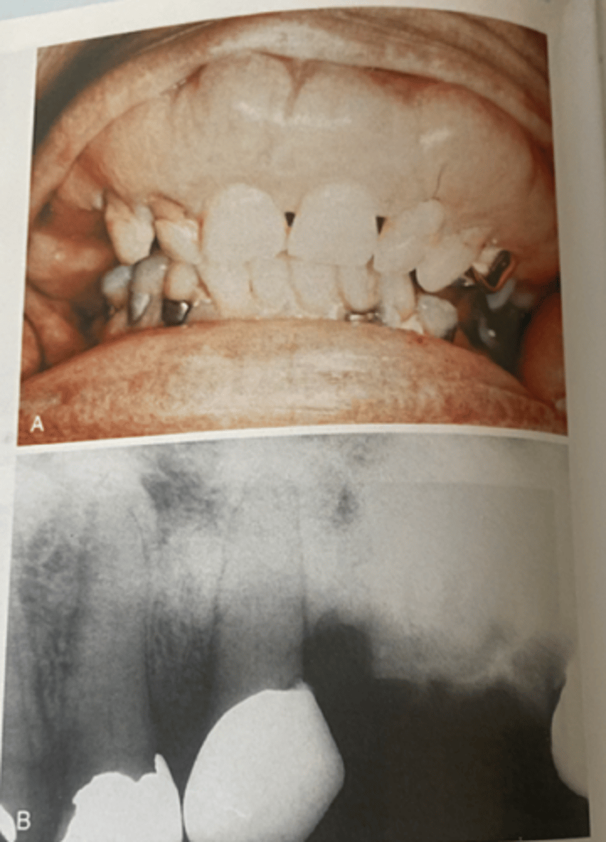 <p>-enlargement of the maxilla with spaces between the teeth</p><p>-radiograph demonstrating irregular opacification that is also referred to as a cotton wool appearance</p>