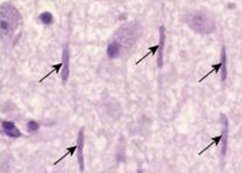 <p><span>arrows point to abnormal aggregates of protein that develop inside nerve cells in Parkinson's disease and certain other neurodegenerative disorders</span></p>