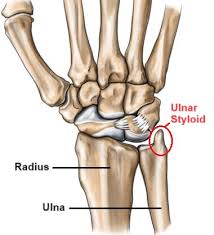<p>Bony bump located on the pinky-finger side of the wrist</p>