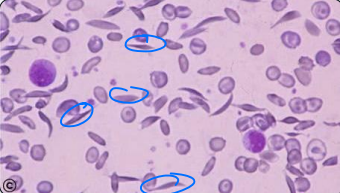 <p>what type of erythrocyte cell is this?</p>