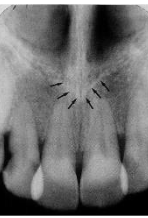 <p>Anterior Nasal Spine</p>